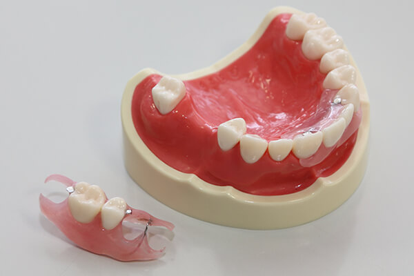 入れ歯の治療期間